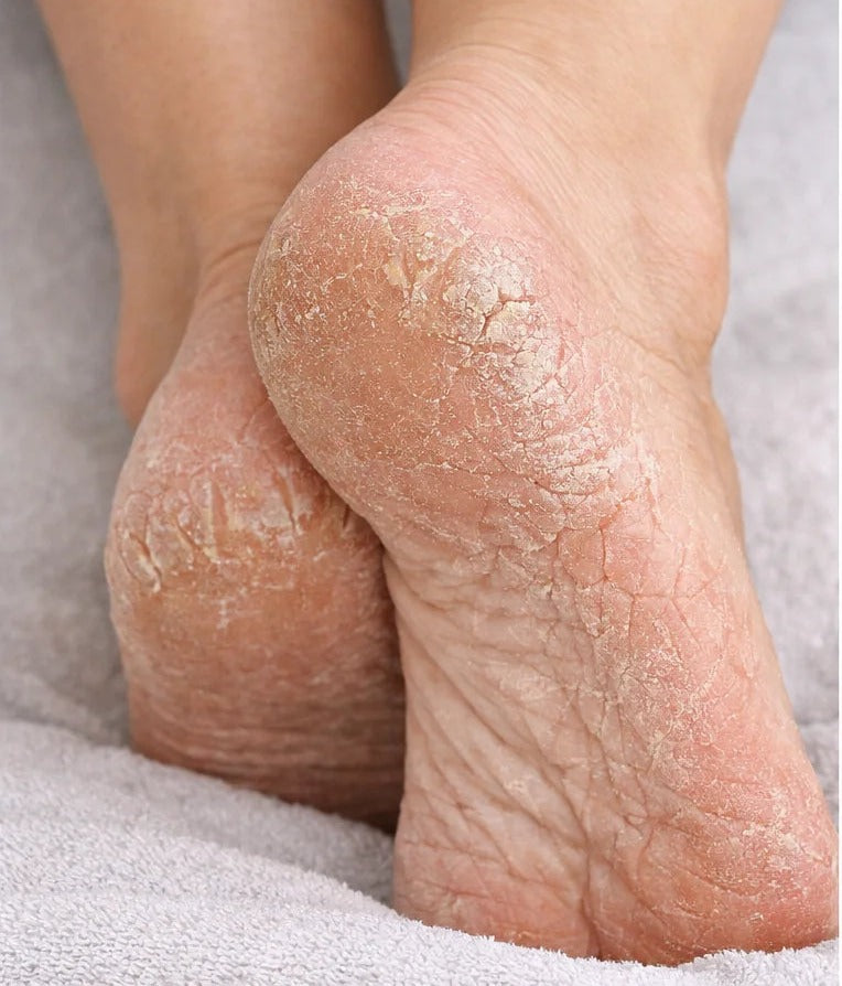 Before — cracked thick heels